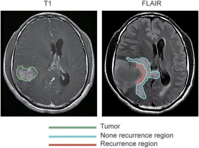 MRI radiomic features of peritumoral edema may predict the recurrence sites of glioblastoma multiforme